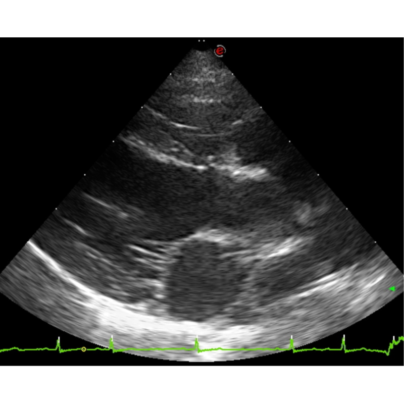 Dépistage des cardiopathies